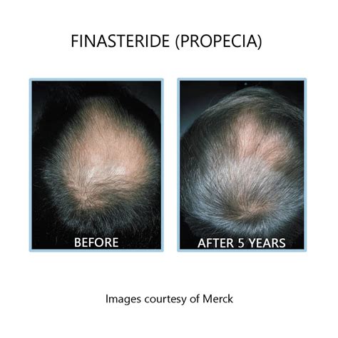 Finasteride Benefits