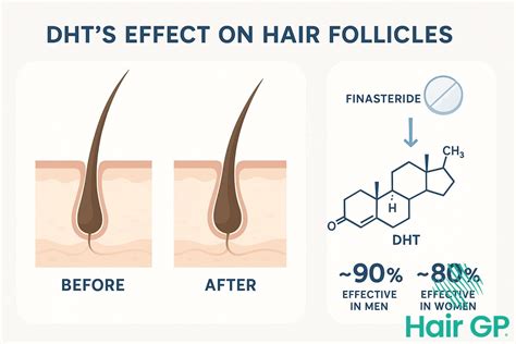 Finasteride Blocking DHT
