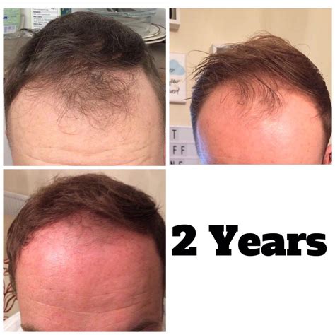 finasteride efficacy hair loss