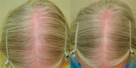 finasteride female hair loss