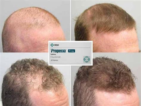 finasteride for hair loss