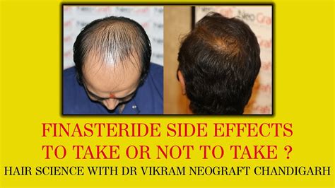 Unveiling Finasteride: The Comprehensive Guide to Halt Hair Loss
