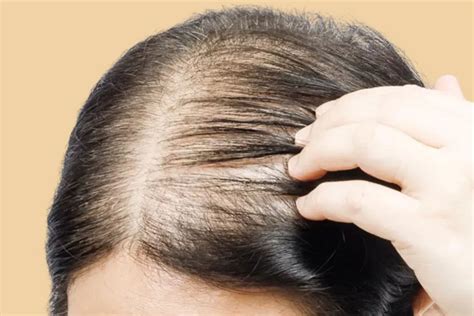 finasteride para que sirve en hombres