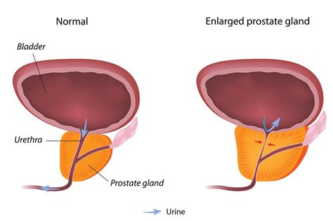 finasteride prostate enlargement