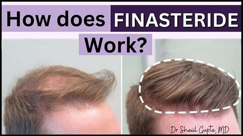 finasteride side effects fda