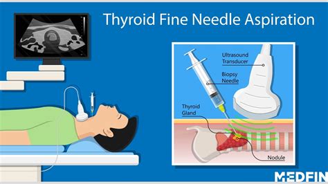 Understanding Fine Needle Aspiration Thyroid: A Minimally Invasive Diagnostic Tool
