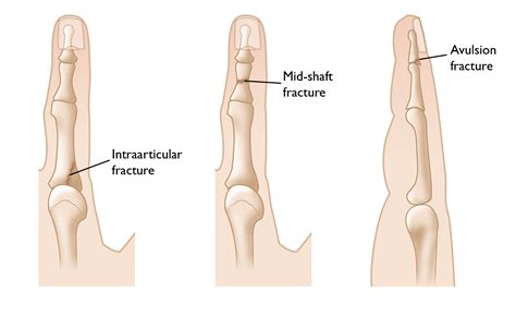 Finger Jam Vs Fracture