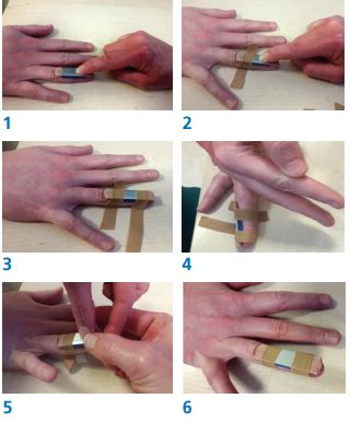 Finger Splint Nhs