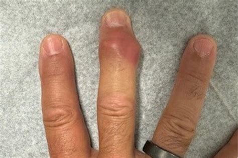 What Happens When Your Finger Swells Up Suddenly?