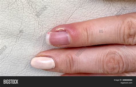 Finger Swollen Around Nail: Causes, Symptoms, and Relief
