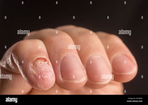 What Happens When You Lose a Finger Without Nail?