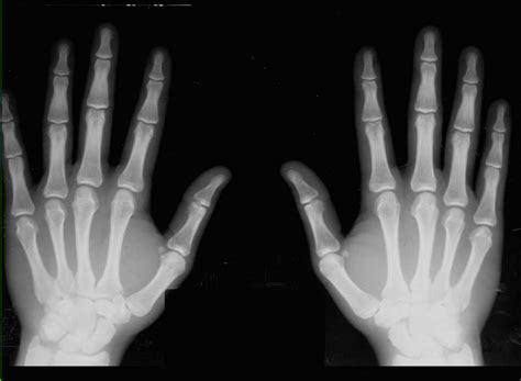 Finger X Ray Guidelines