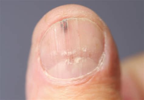 fingernail melanoma early stages