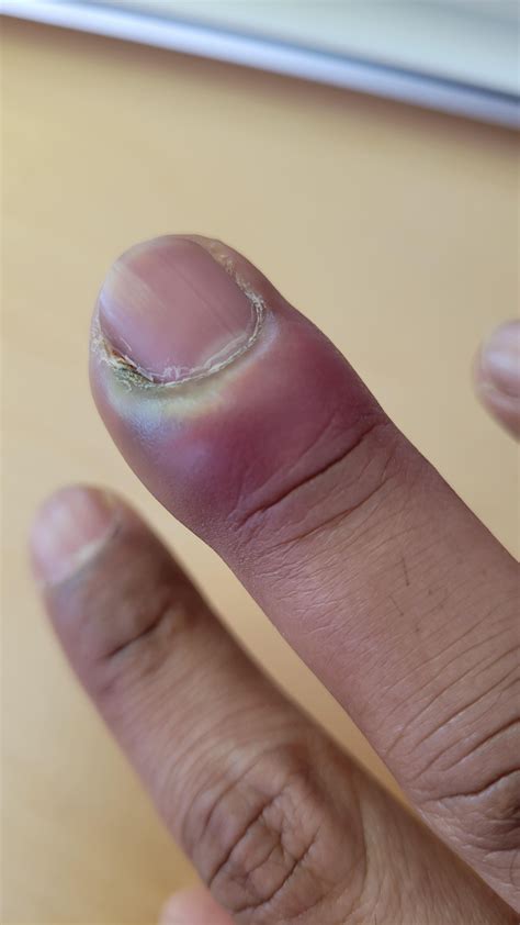 Fingers Burning From