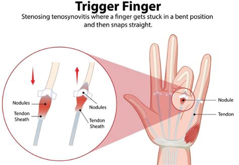 Fingers Locking Up Concussion