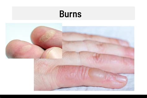 Fingertips Burning And Sore