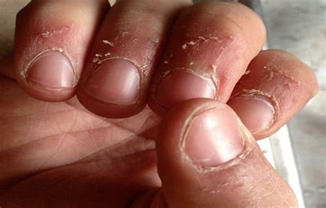 Fingertips Peeling Around Nails