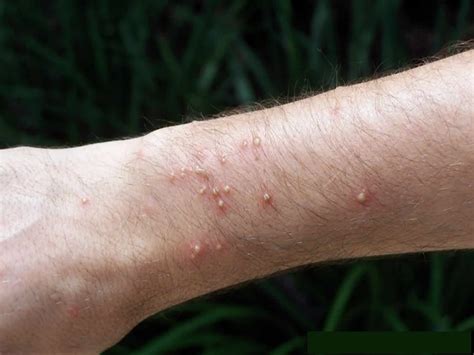 fire ant bite icd 10