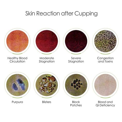 Fire Cupping Side Effects