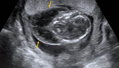 First Trimester Ultrasound Cystic Hygroma Ultrasound Large (arrows).