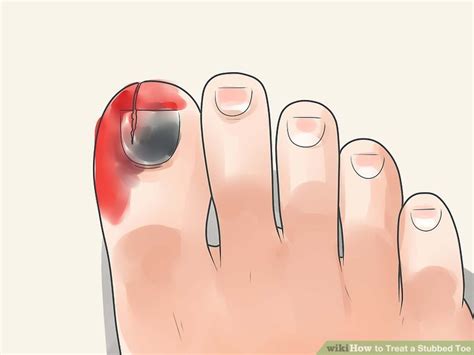 first aid for stubbed toe