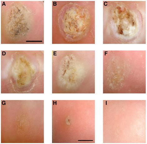 first stage of a wart