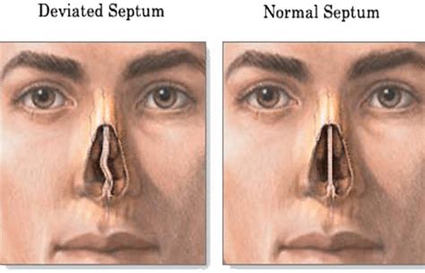Breathe Easy: How to Fix Deviated Septum Naturally