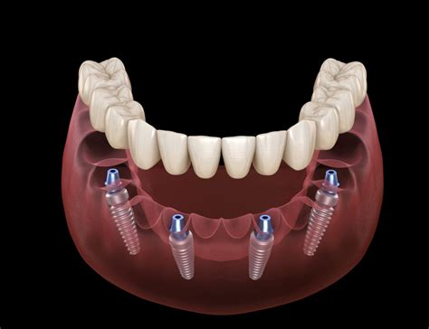 Fixed Implant Prosthesis