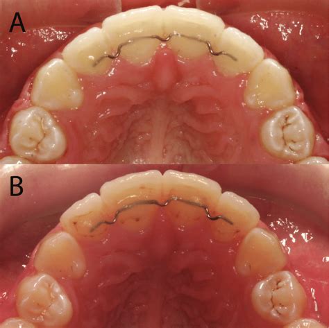 Fixed Lingual Retainer Code