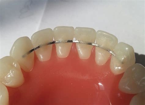 Fixed Lingual Retainer Dental Code