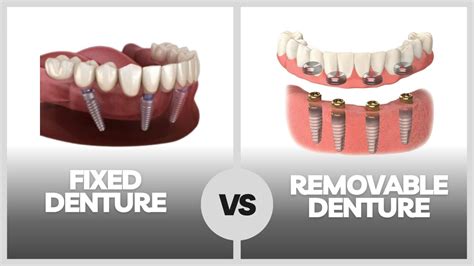 Fixed Removable Denture