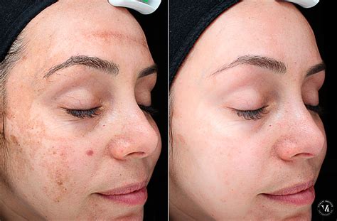Chemical Peels for Acne and Anti Aging 5th TCA Chemical Peel day 4