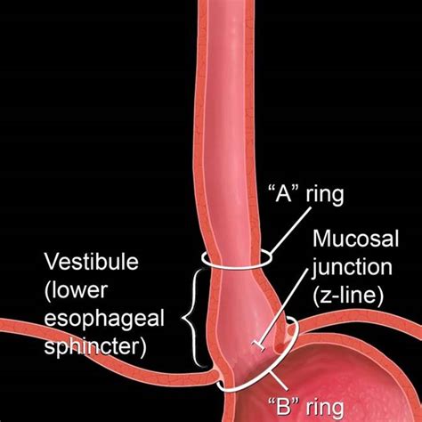 flap at bottom of esophagus