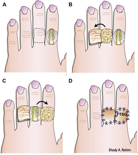 Flap Of Skin On Finger Cut