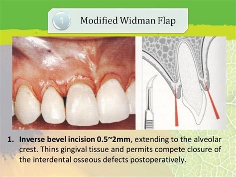 Flap Reflection Definition