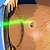 flashing lights retinal detachment