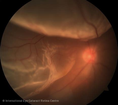 Flashing Lights After Eye Surgery