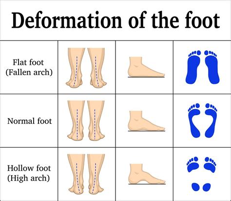 Flat Feet Bad Shoes