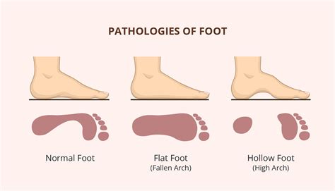 Flat Feet vs Normal: Surprising Differences Revealed!