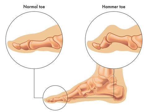 Flat Foot And Hammer Toe