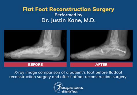 flat foot reconstruction procedure