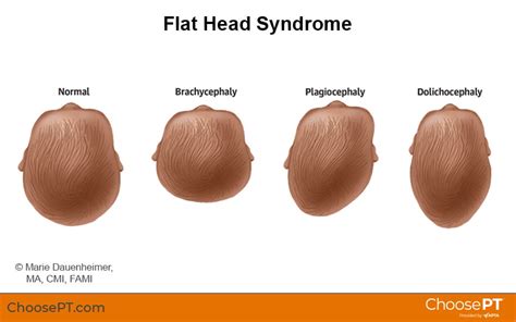 Understanding Flat Head Syndrome: Causes and Effective Treatments