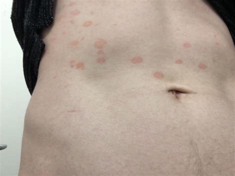 flat red spots on stomach not itchy