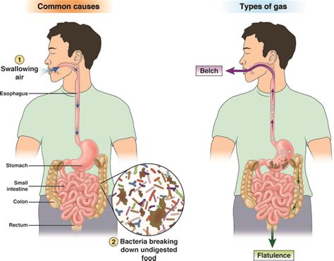 Flatulence And Gas Problem