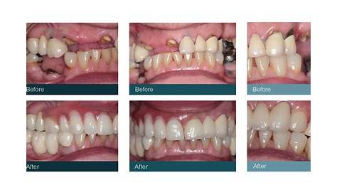 Dental rehabilitation with lower flexible nylon denture