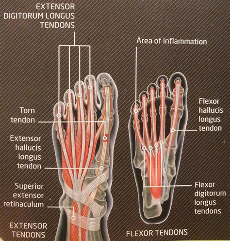 Flexor Tendon Leg Injury Symptoms