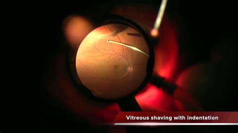 floater only vitrectomy safety