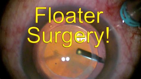 floaters only vitrectomy cost