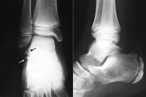 Floating Bone In Ankle Joint