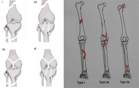 Floating Knee Definition